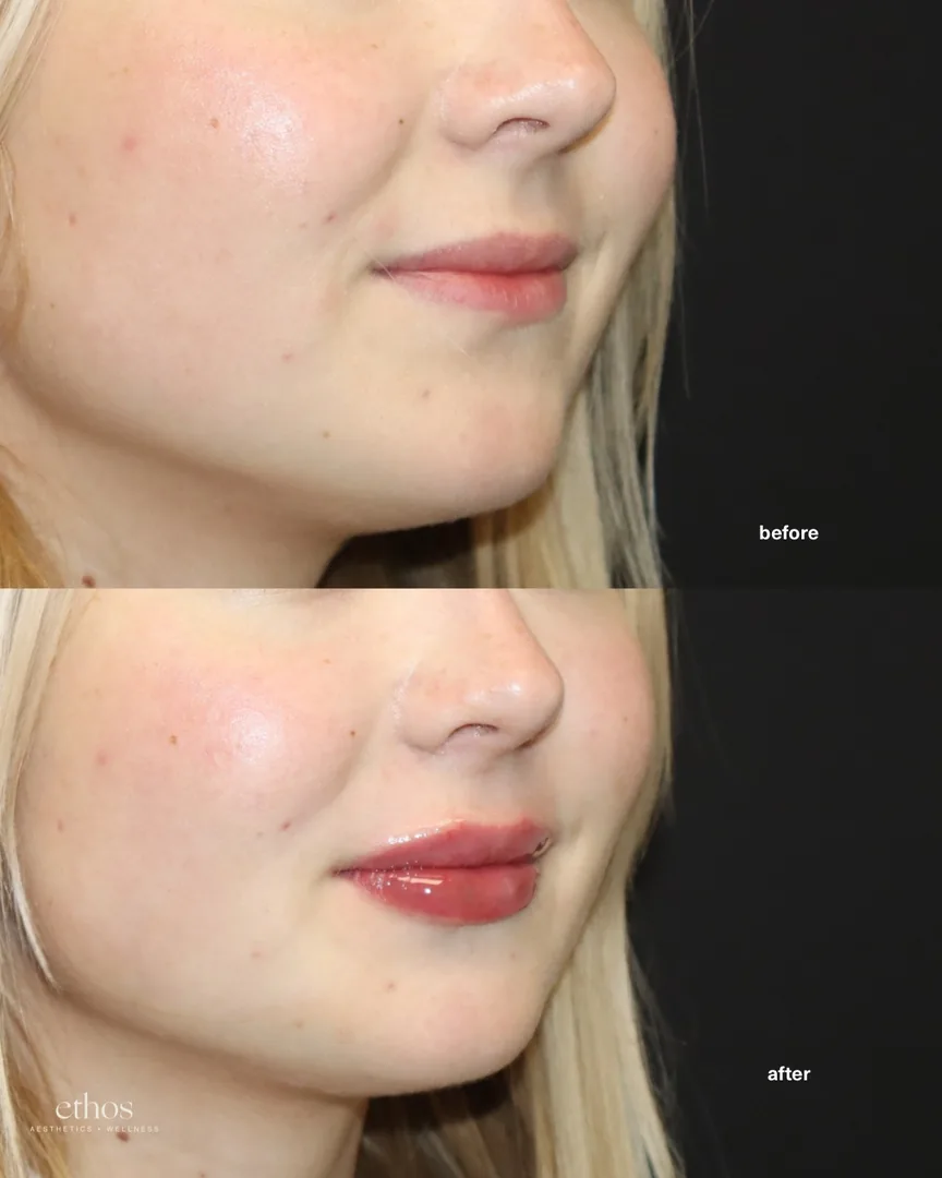 Lip filler before and after results 24