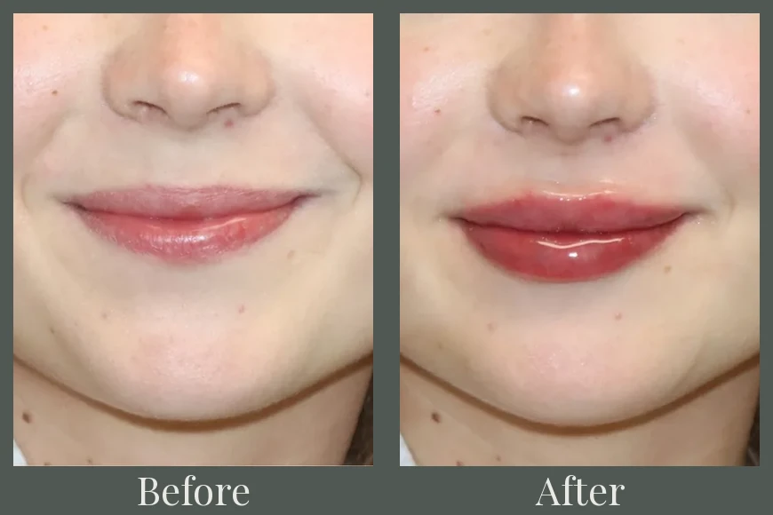 Lip filler before and after