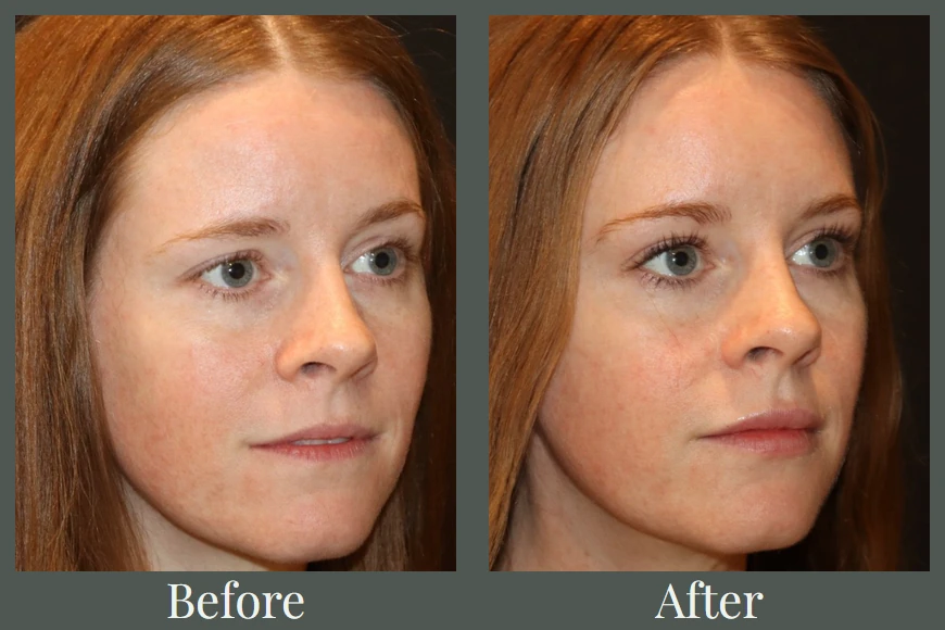 Lip filler and Botox before and after