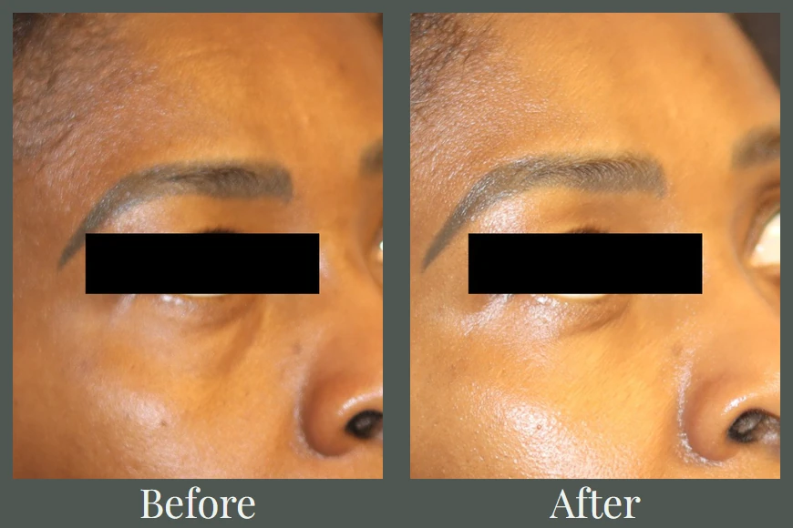 Under-eye filler before and after — tear trough correction