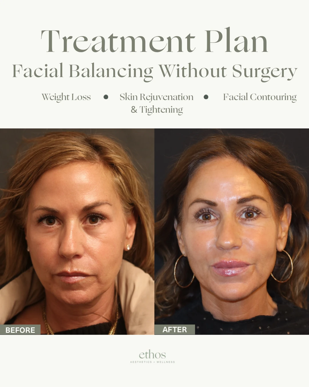 Treatment plan case study — facial balancing without surgery, before and after