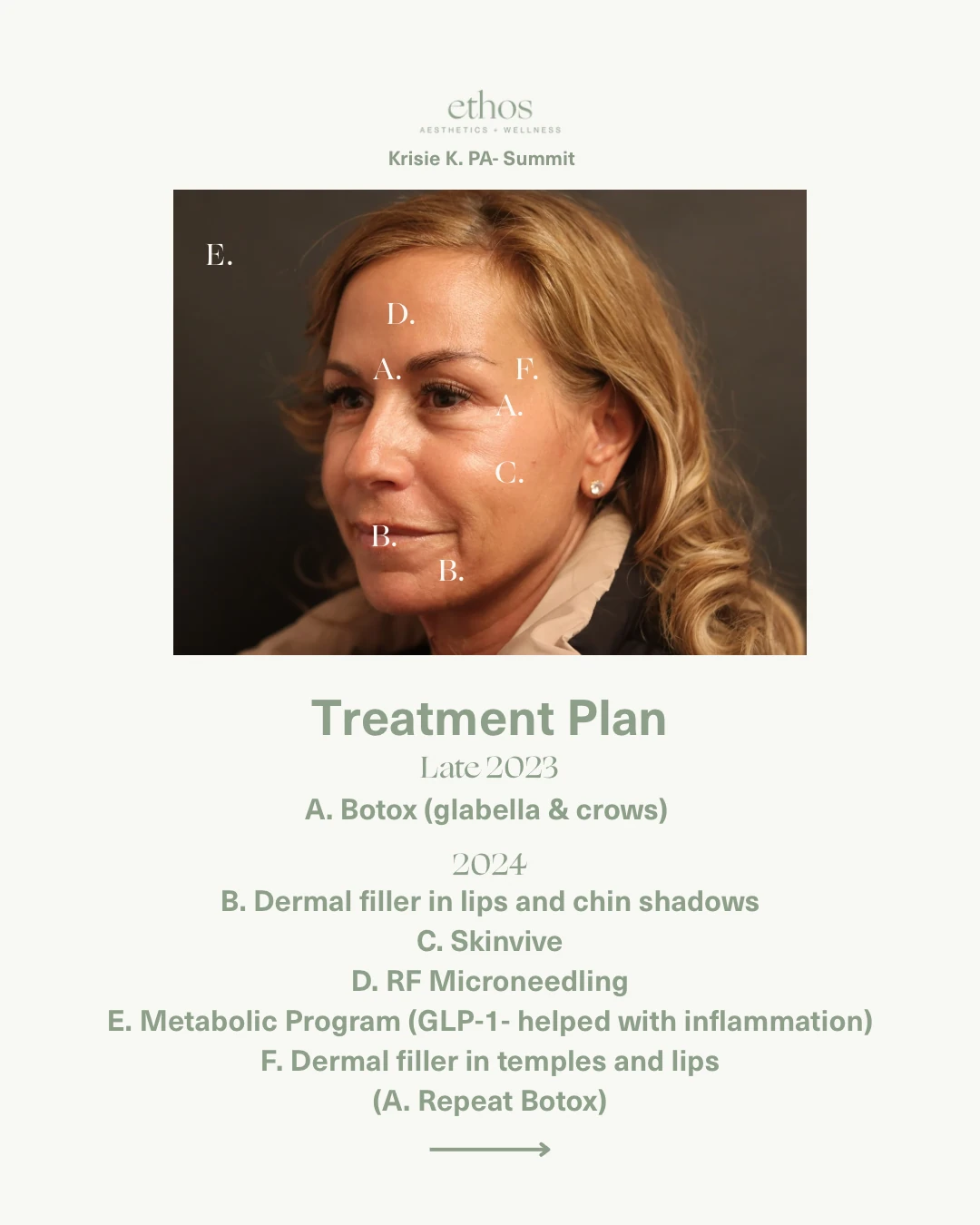 Case study treatment plan late 2023 and 2024 — Botox, dermal filler, Skinvive, RF microneedling