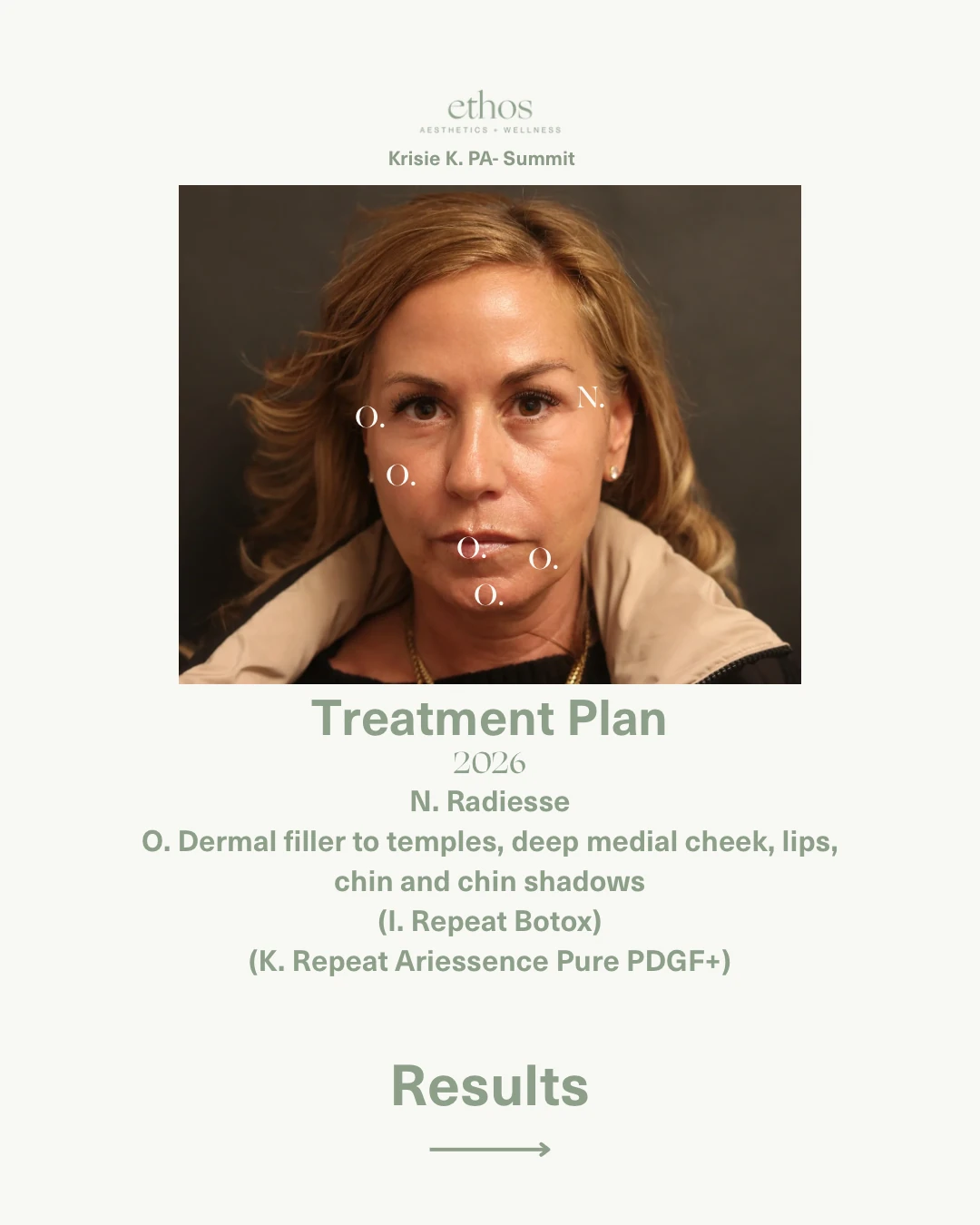 Case study treatment plan 2026 — Radiesse and dermal filler