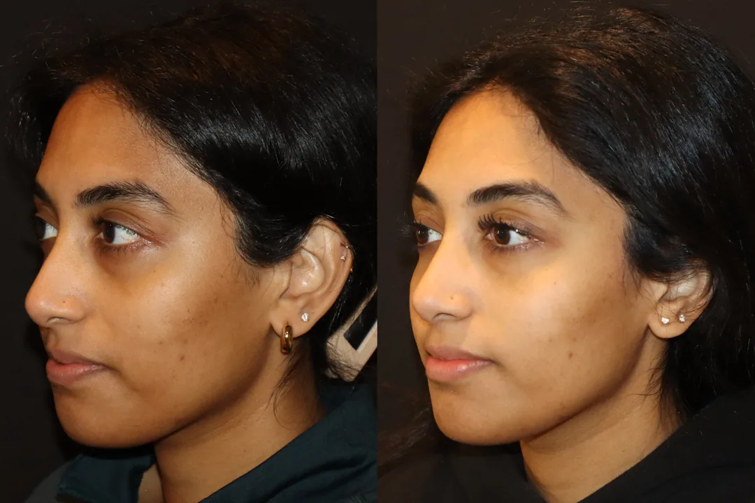 Facial balancing before and after