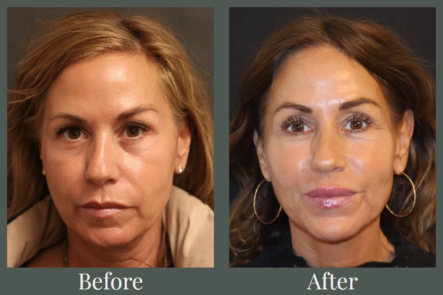 Facial balancing case study before and after — front view