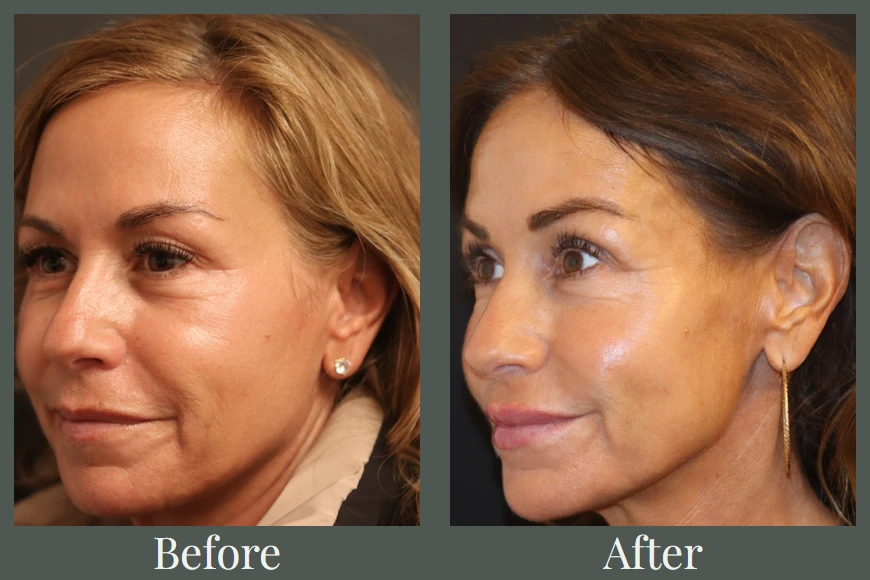 Facial balancing case study before and after — three-quarter view