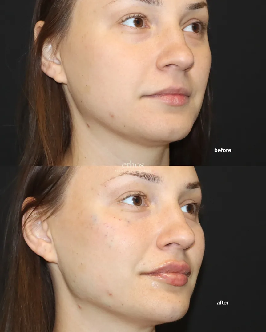 Facial balancing before and after