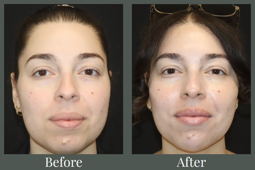 Full face filler and Botox before and after — front view