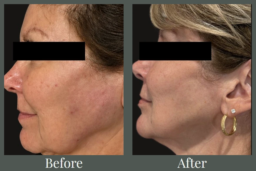 Full face filler and Botox before and after — profile