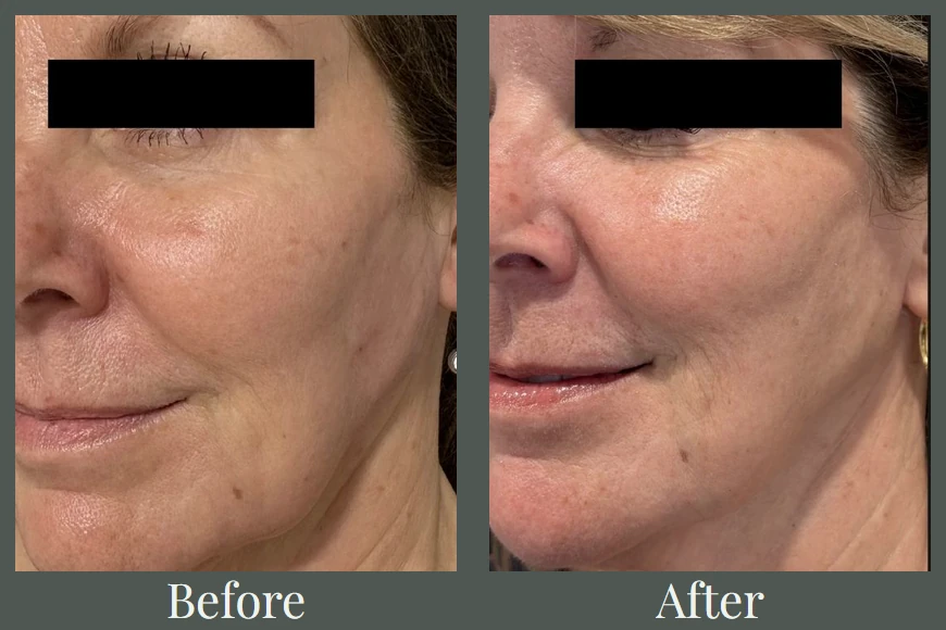 Full face filler and Botox before and after — three-quarter view