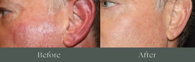 Laser hair removal before and after