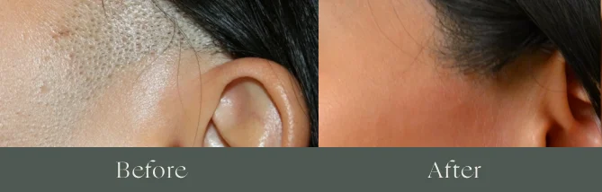 Laser hair removal before and after
