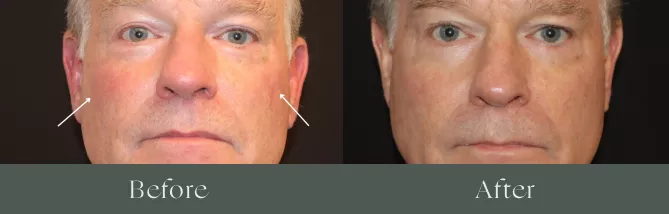 Laser hair removal before and after