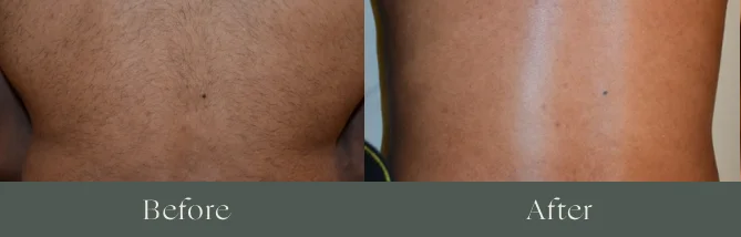 Laser hair removal before and after