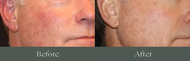 Laser hair removal before and after