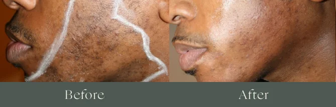Laser hair removal before and after
