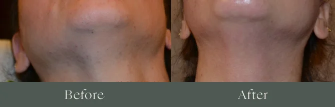 Laser hair removal before and after