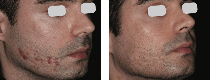 M22 skin treatment before and after