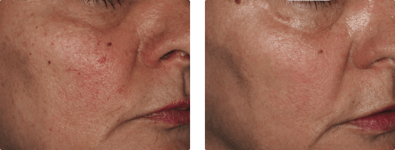 M22 skin treatment before and after