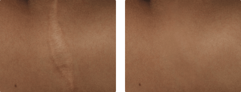 M22 skin treatment before and after