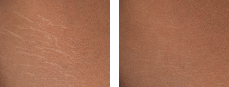 M22 skin treatment before and after