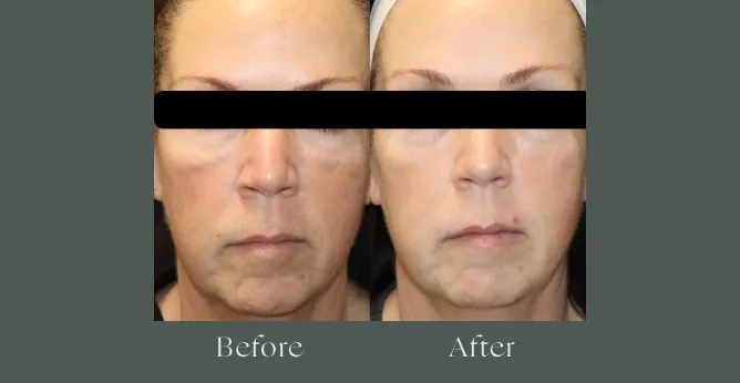 Microneedling before and after