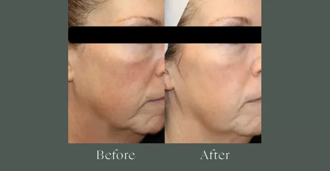 Microneedling before and after