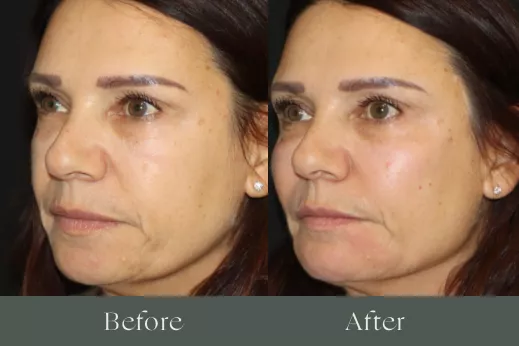 Radiesse before and after