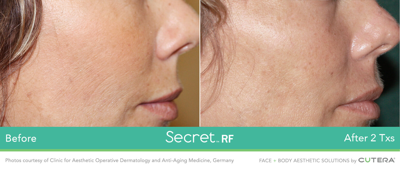 RF microneedling before and after