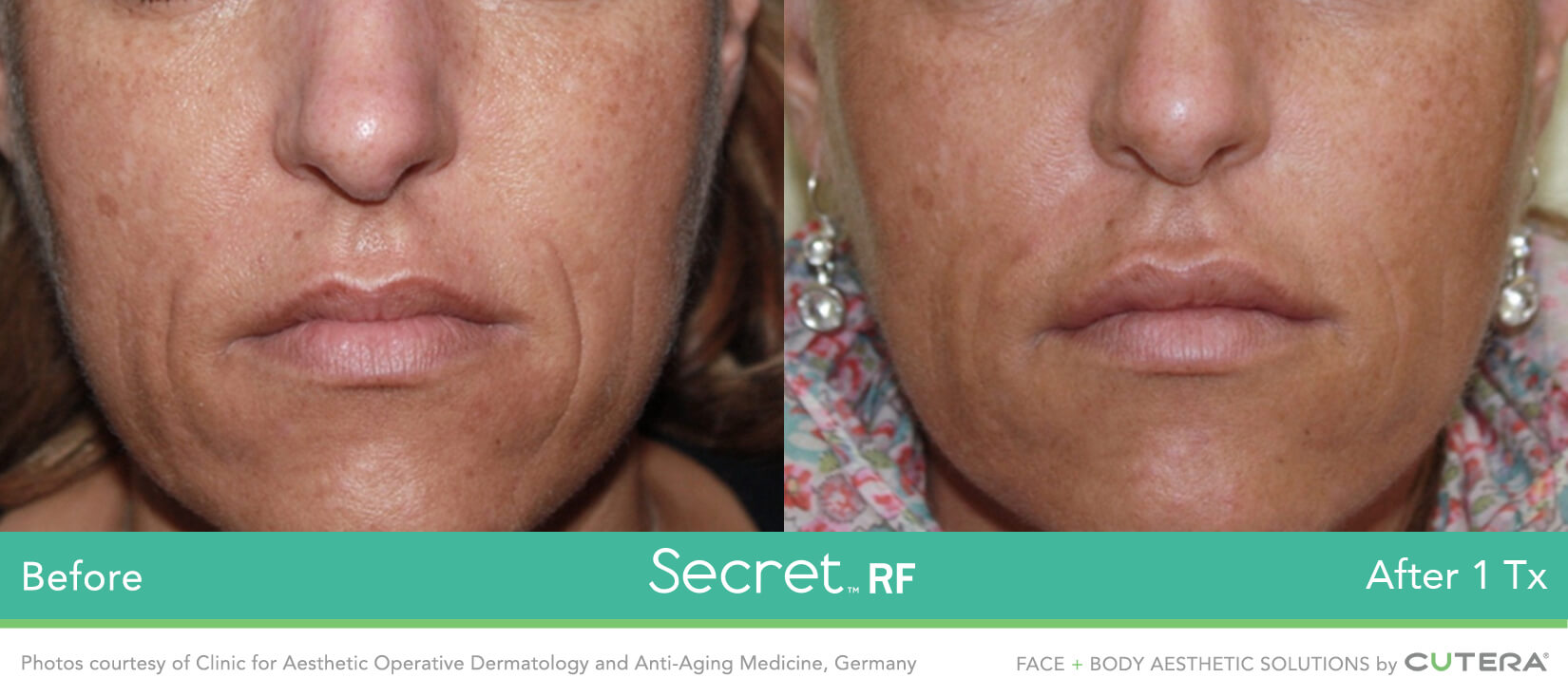 RF microneedling before and after