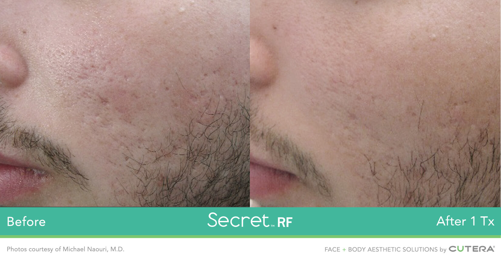 RF microneedling before and after