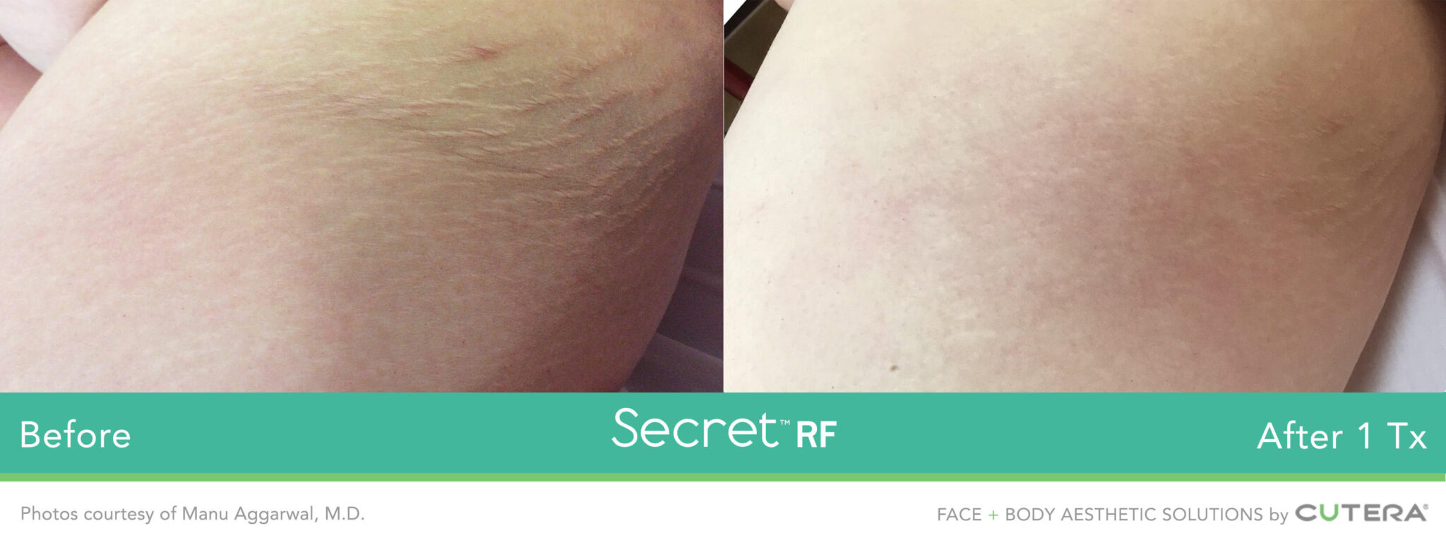 RF microneedling before and after