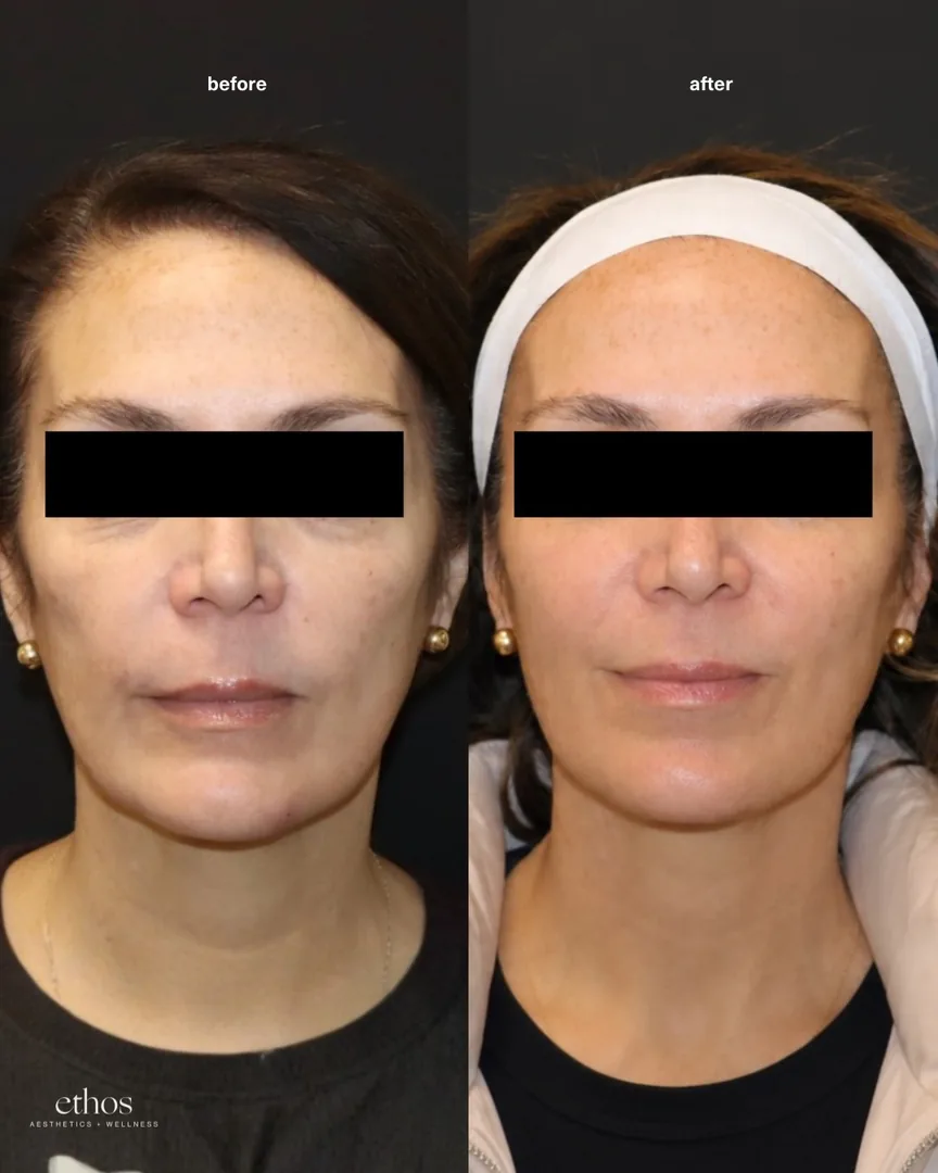 Sculptra before and after