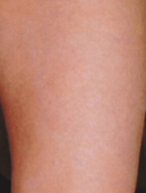 Tattoo removal after