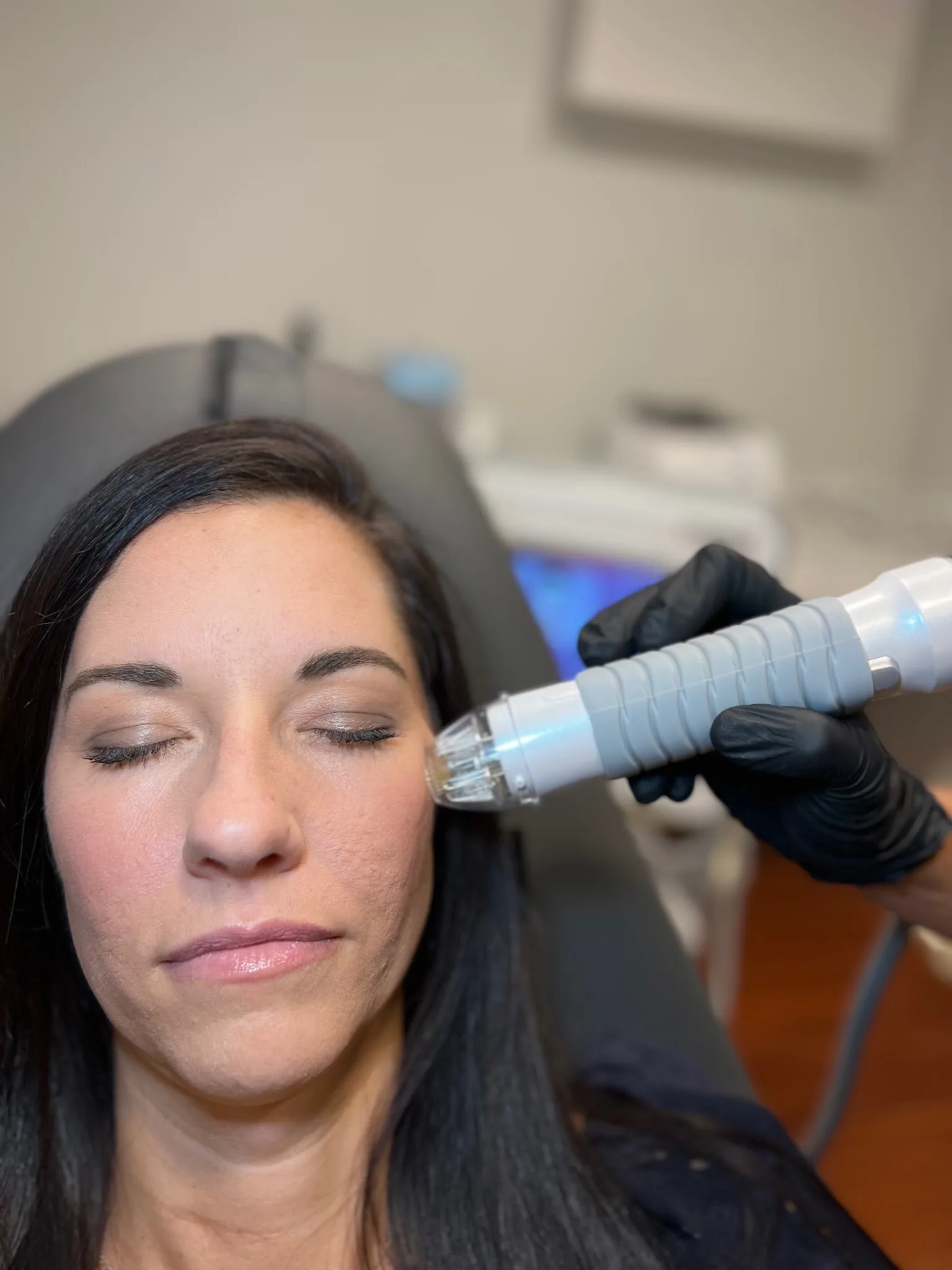 Microneedling collagen induction therapy