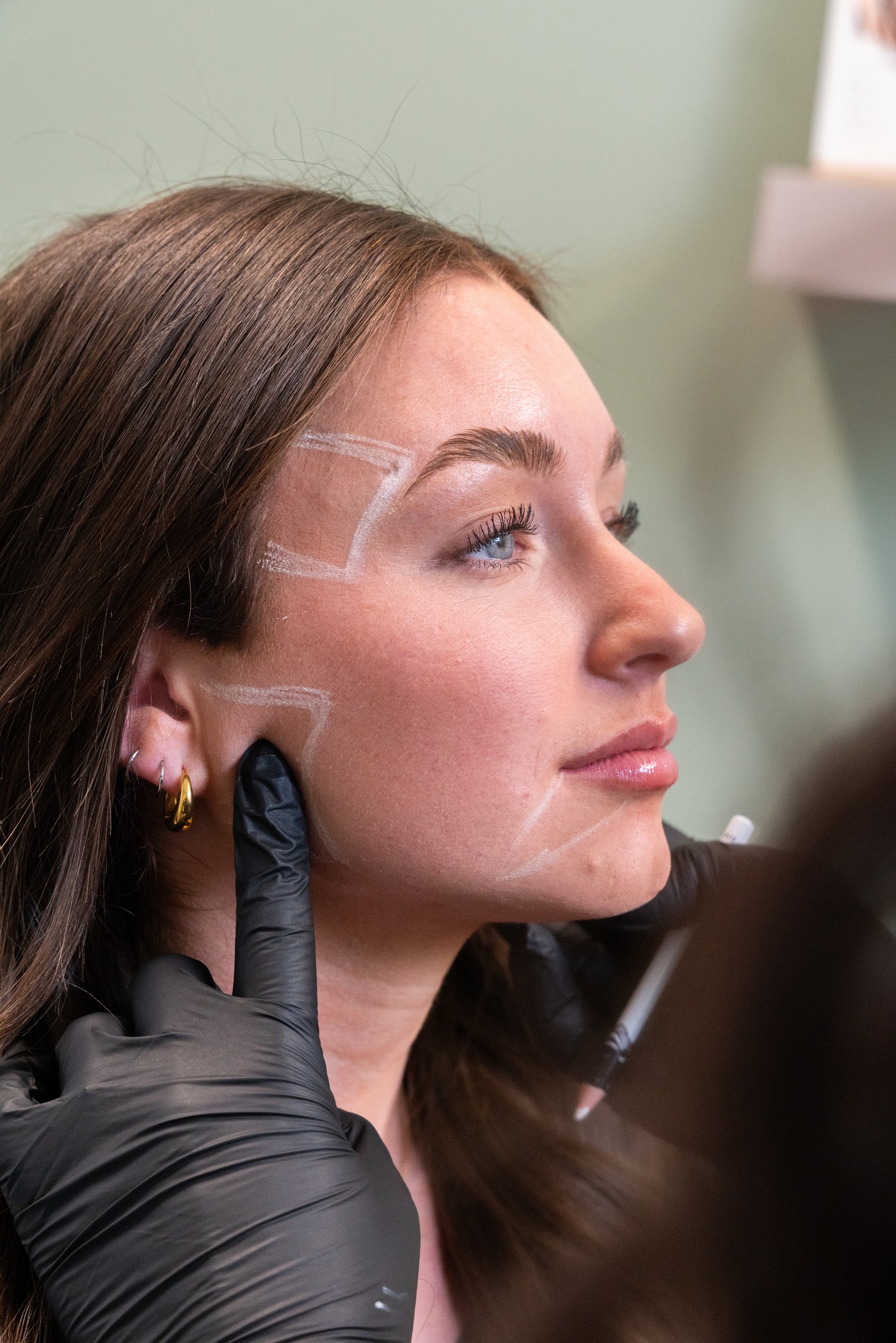 RHA filler injection