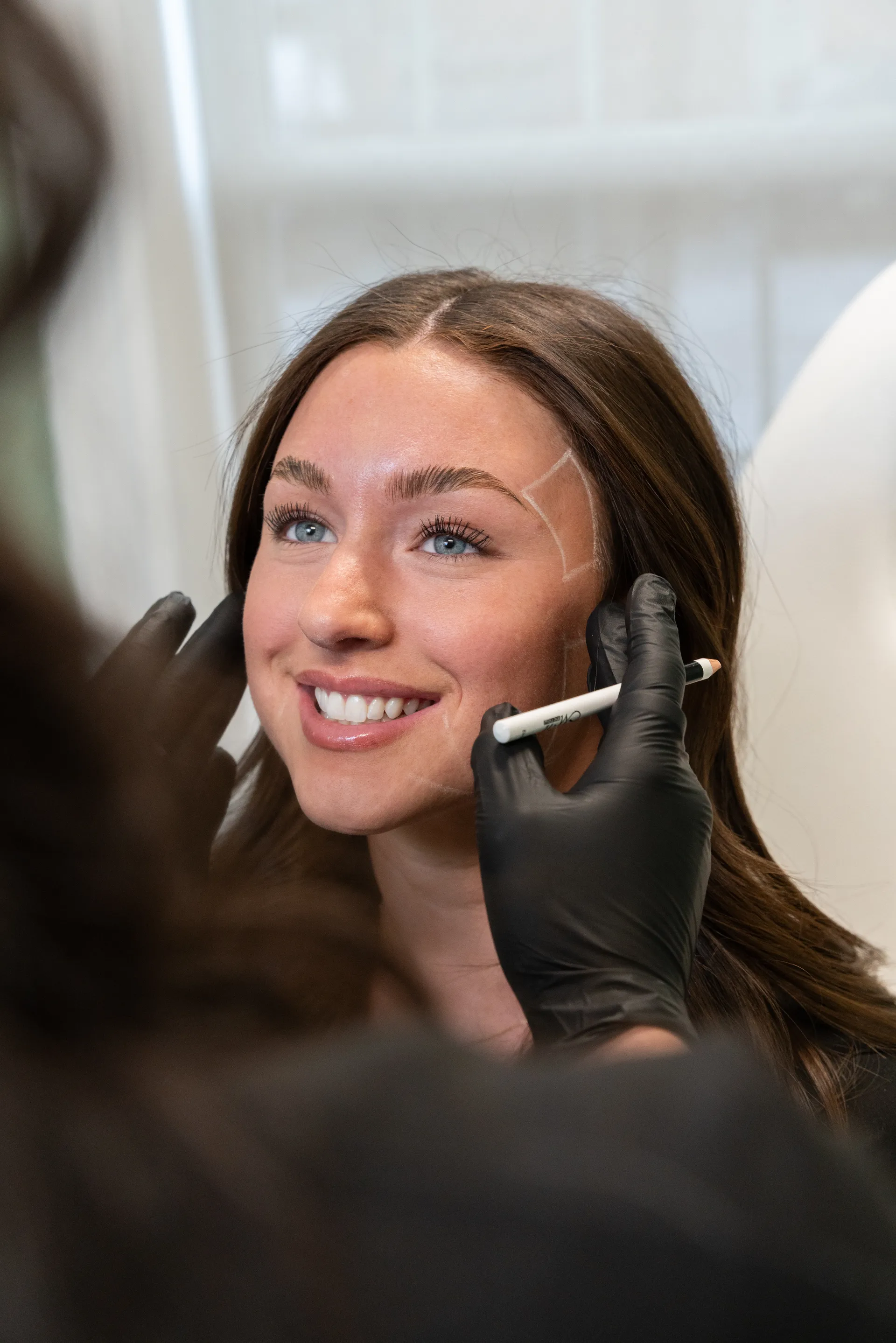 Sculptra biostimulator treatment