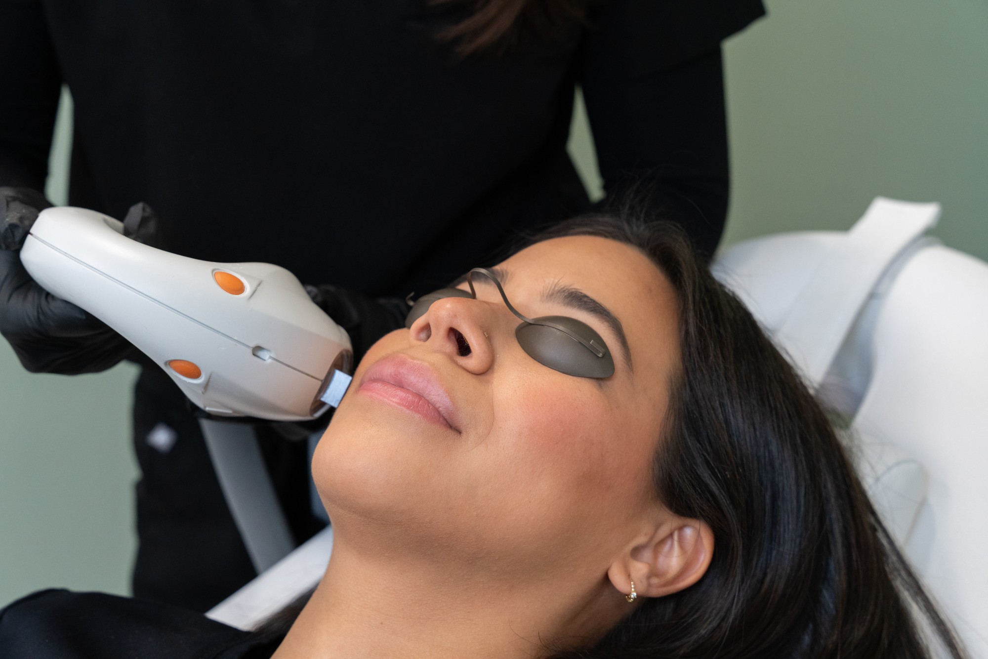 M22 IPL photofacial treatment