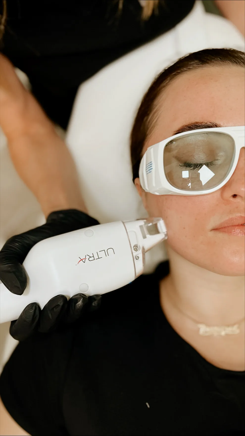 Ultra Lase skin treatment